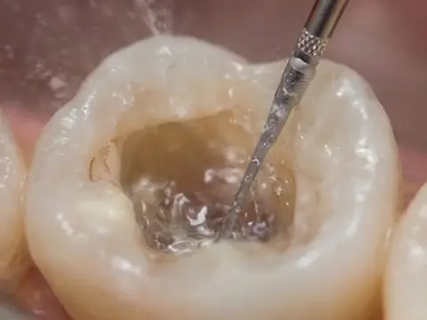 Ultrassom odontológico